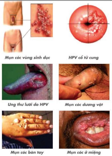 Các loại tổn thương do virus HPV gây ra