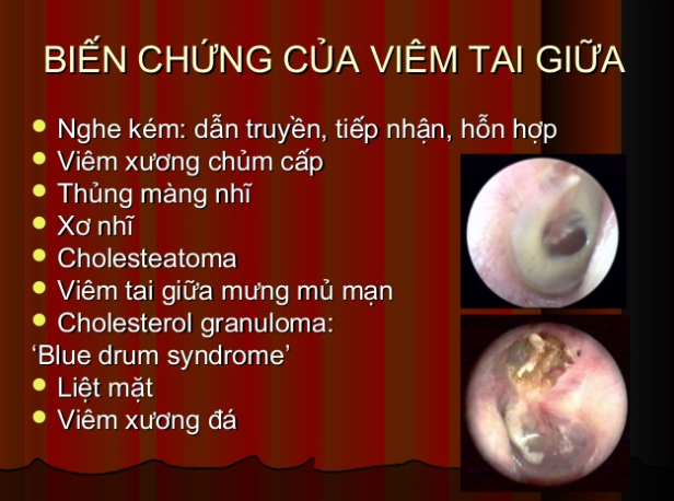 Một số biến chứng nguy hiểm của viêm tai giữa