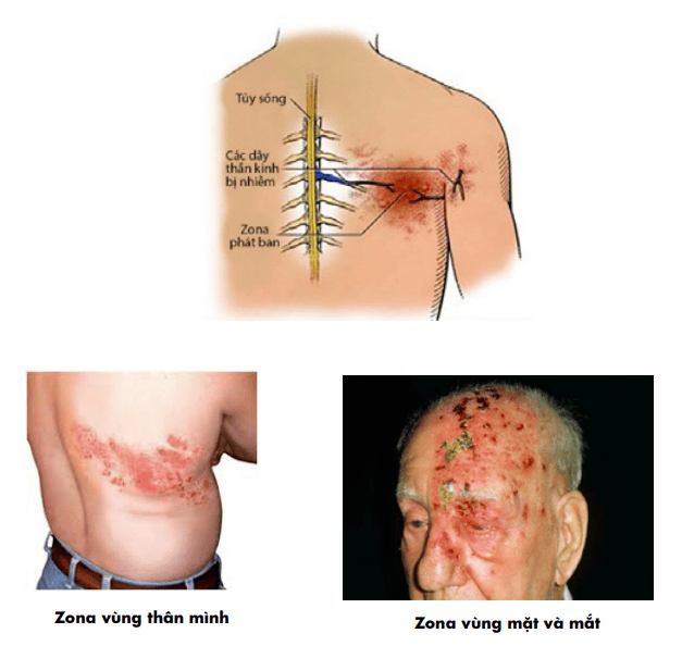 triệu chứng của zona thần kinh