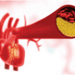 Bệnh động mạch vành có nguy hiểm không?