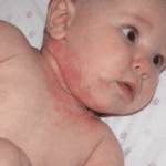 Những điều cần biết về bệnh sởi