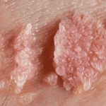 Bệnh sùi mào gà