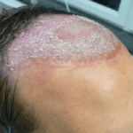 Biến chứng nguy hiểm của cấy tóc chữa hói đầu không đạt tiêu chuẩn