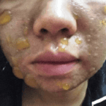 Bỏng da vì dùng mỹ phẩm không đạt tiêu chuẩn