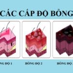 Xử trí bỏng phụ thuộc vào cấp độ tổn thương