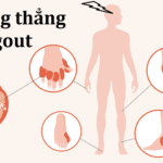 căng thẳng gây khởi phát cơn gout cấp
