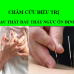 châm cứu điều trị đau thắt ngực ổn định