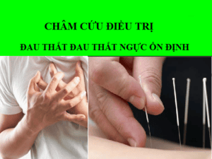 châm cứu điều trị đau thắt ngực ổn định