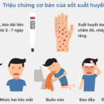 Dấu hiệu của sốt xuất huyết