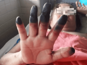 Hình ảnh ngón tay hoại tử