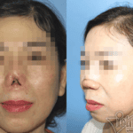Chị Tuyết bị khuyết tổn đầu mũi, trụ mũi và cánh mũi (ảnh trái) và hình ảnh sau phẫu thuật