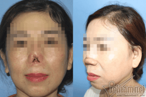 Chị Tuyết bị khuyết tổn đầu mũi, trụ mũi và cánh mũi (ảnh trái) và hình ảnh sau phẫu thuật