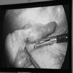 Mổ ruột thừa bất ngờ phát hiện xương cá đâm xuyên thành ruột hiếm gặp