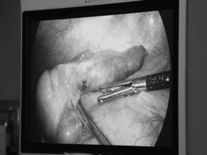 Mổ ruột thừa bất ngờ phát hiện xương cá đâm xuyên thành ruột hiếm gặp