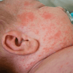 Nhận biết trẻ bị sởi