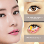 Quy trình phẫu thuật thẩm mỹ mí mắt