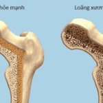 Phòng tránh loãng xương