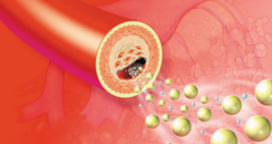 Rối loạn mỡ máu có nhiều tên gọi khác nhau như máu nhiễm mỡ, mỡ máu cao, rối loạn lipid máu