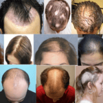 điều trị rụng tóc