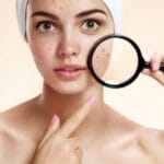 Sai lầm trong điều trị mụn trứng cá