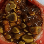 Túi mật chứa hàng trăm viên sỏi kích thước lớn, nhỏ được phẫu thuật lấy ra