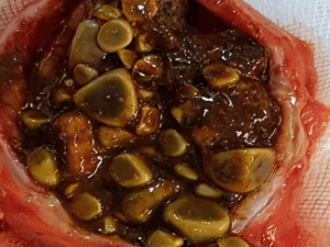 Túi mật chứa hàng trăm viên sỏi kích thước lớn, nhỏ được phẫu thuật lấy ra