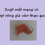 Suýt mất mạng vì lọt răng giả vào thực quản