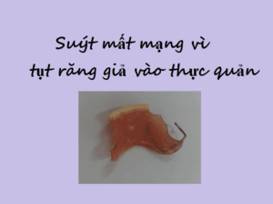 Suýt mất mạng vì lọt răng giả vào thực quản