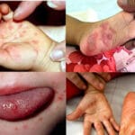 Phát hiện trẻ bị tay chân miệng