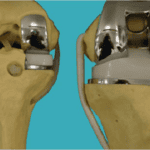 Thay khớp gối nhân tạo