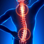 Điều trị thoát vị đĩa đệm