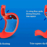 GERD do cơ vòng thực quản không đóng kín