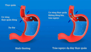 GERD do cơ vòng thực quản không đóng kín