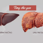 triệu chứng ung thư gan