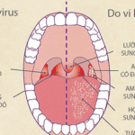 Viêm họng do vi khuẩn uống thuốc gì?
