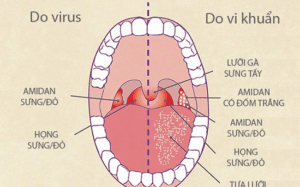 Viêm họng do vi khuẩn uống thuốc gì?
