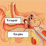 Viêm tai giữa có nguy hiểm không?