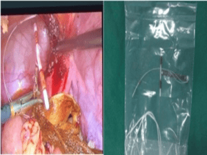 Vòng tránh thai gây rong kinh